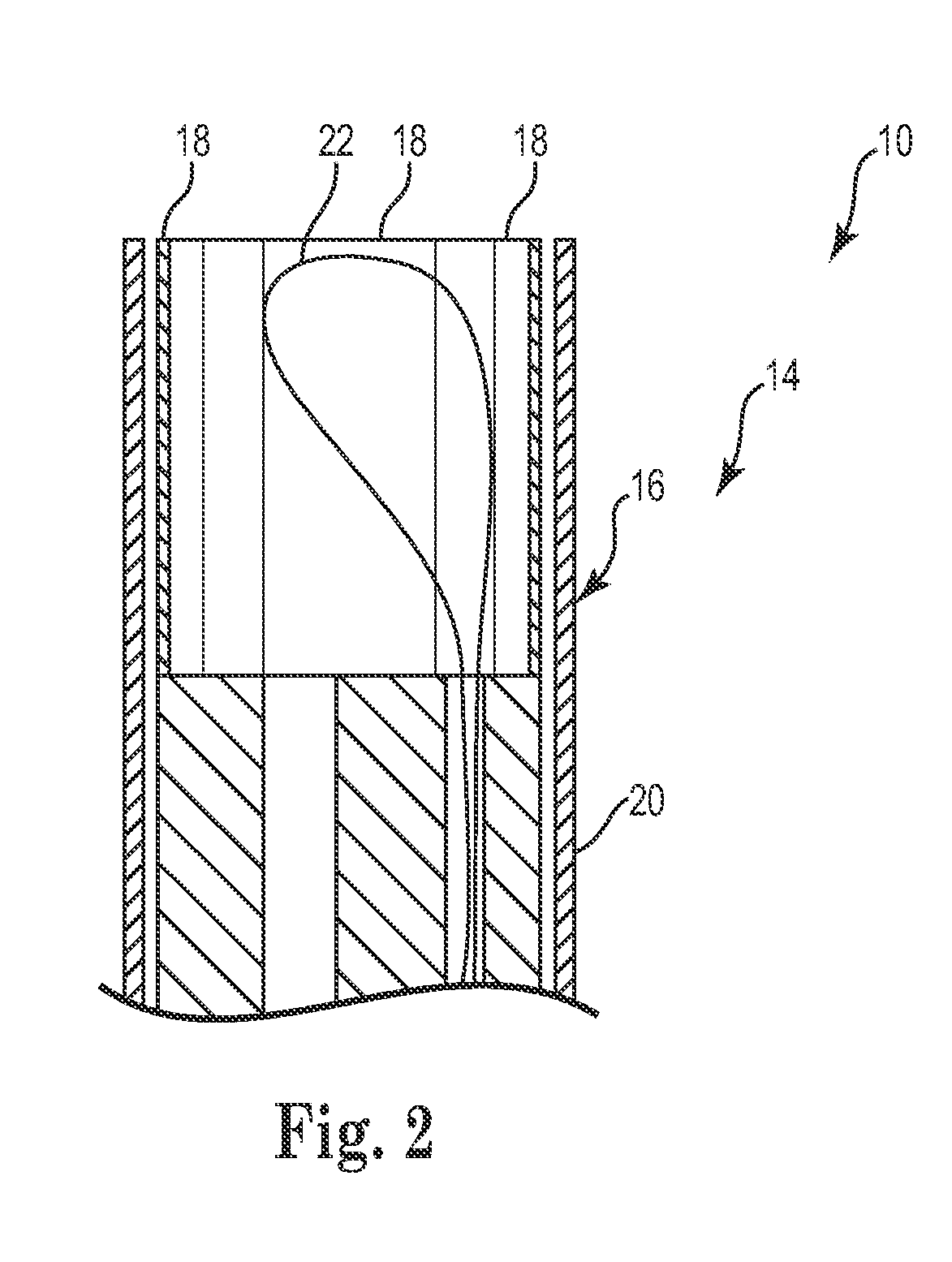 Necrosectomy assist device