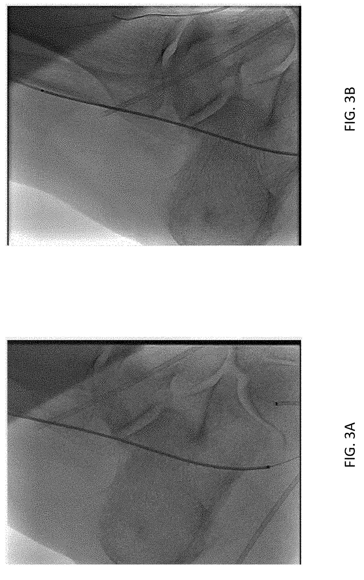 Method and apparatus for treating critical limb ischemia