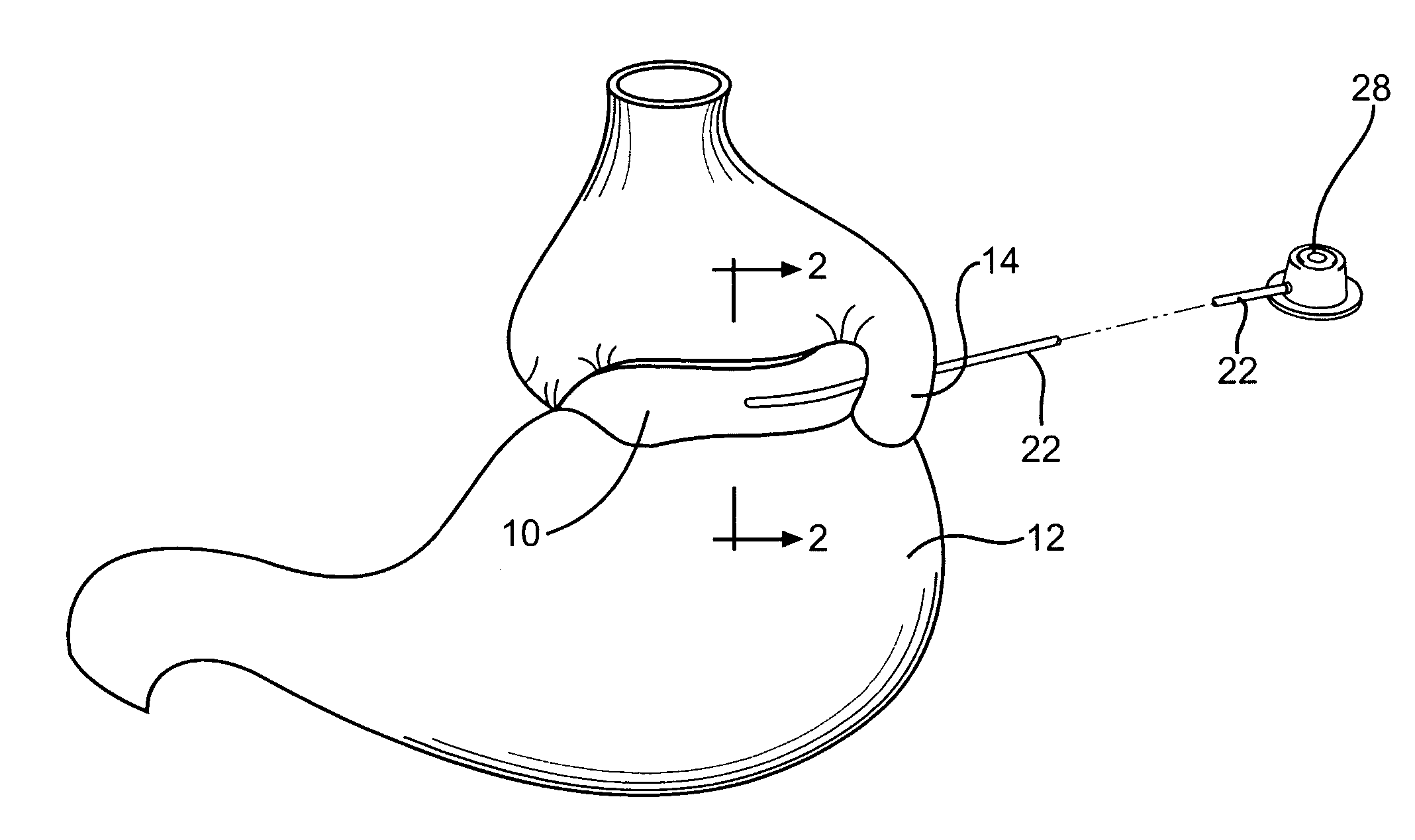 Implantable band having improved attachment mechanism