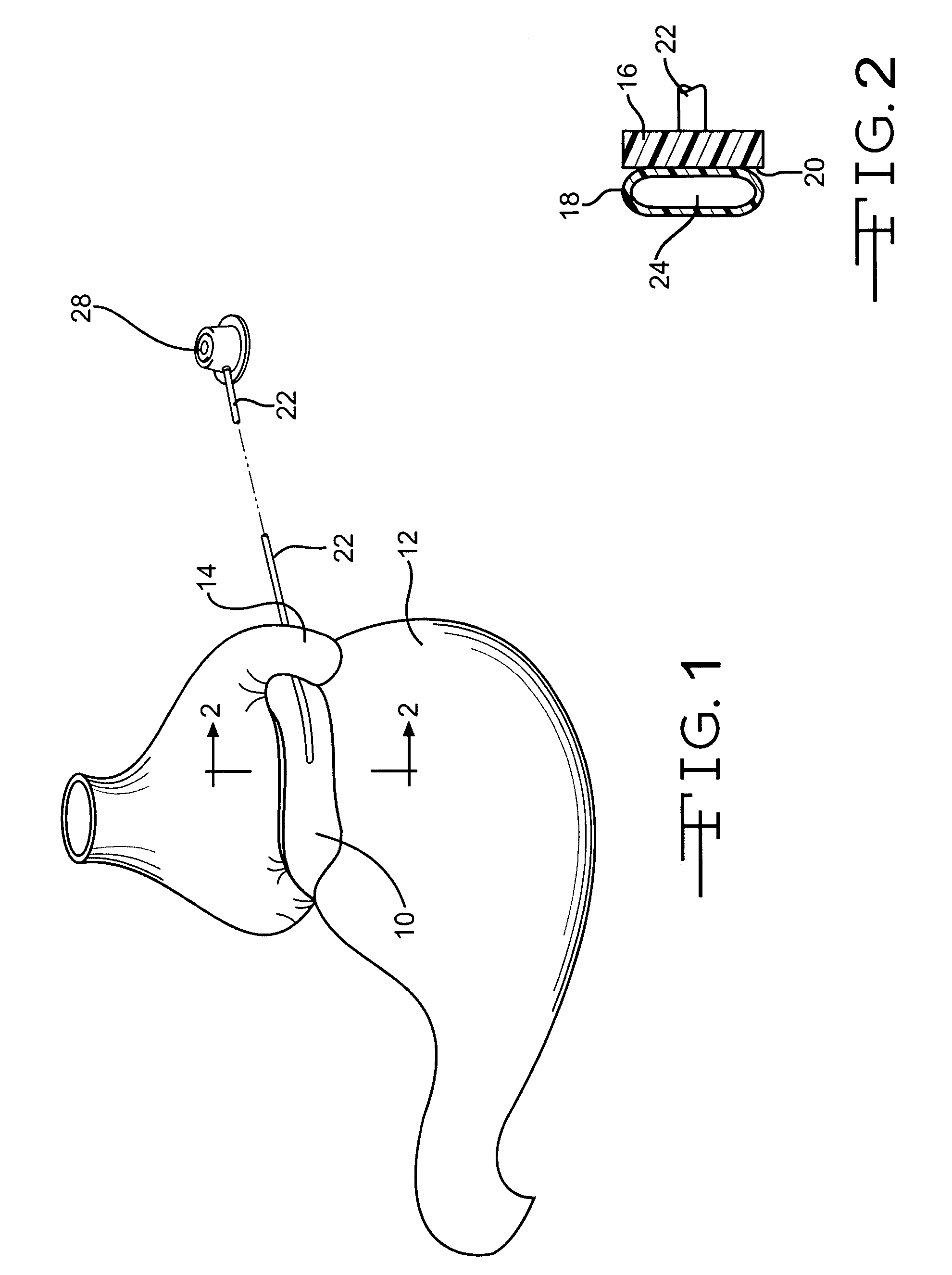 Implantable band having improved attachment mechanism