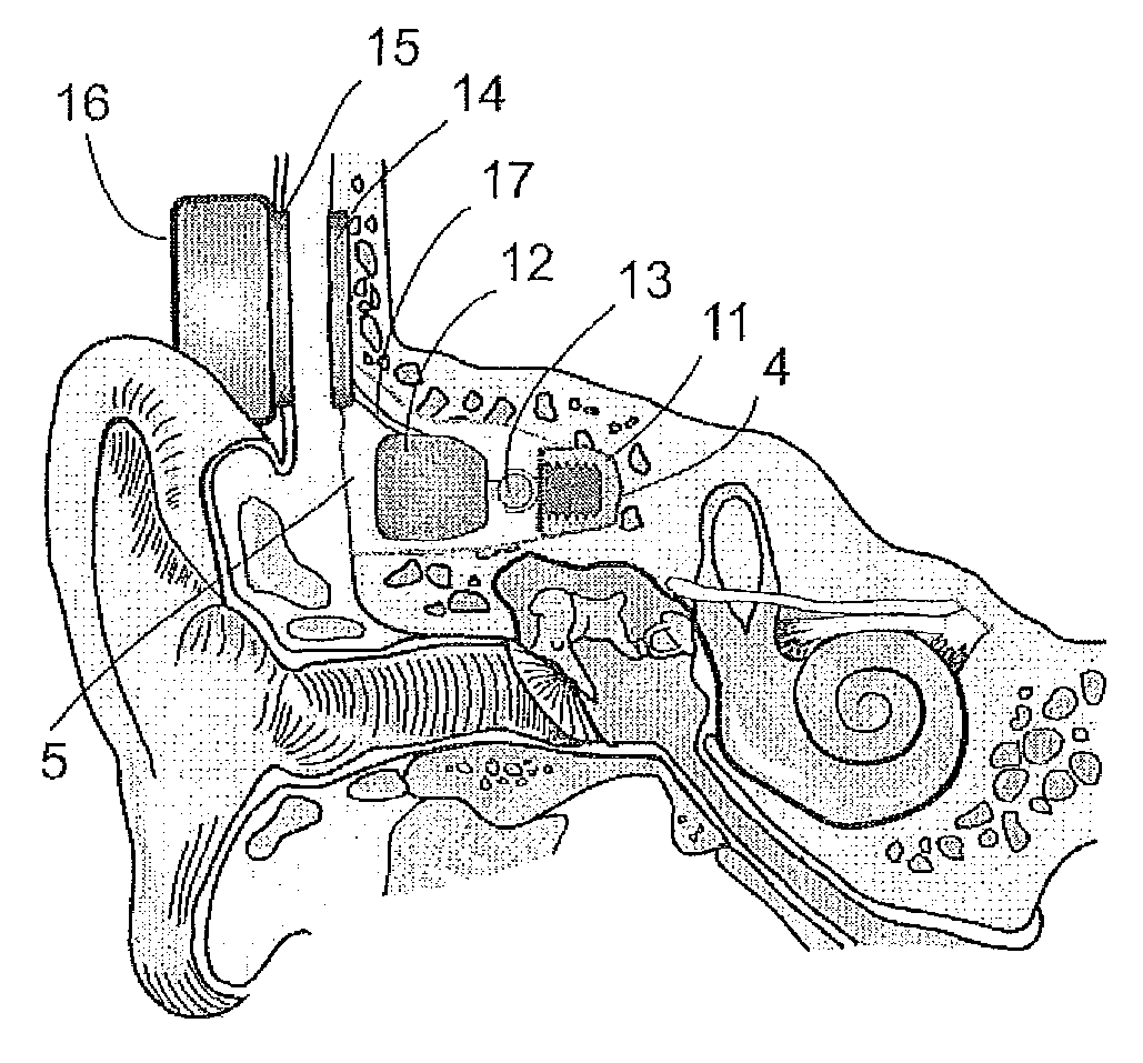 Implantable transducer