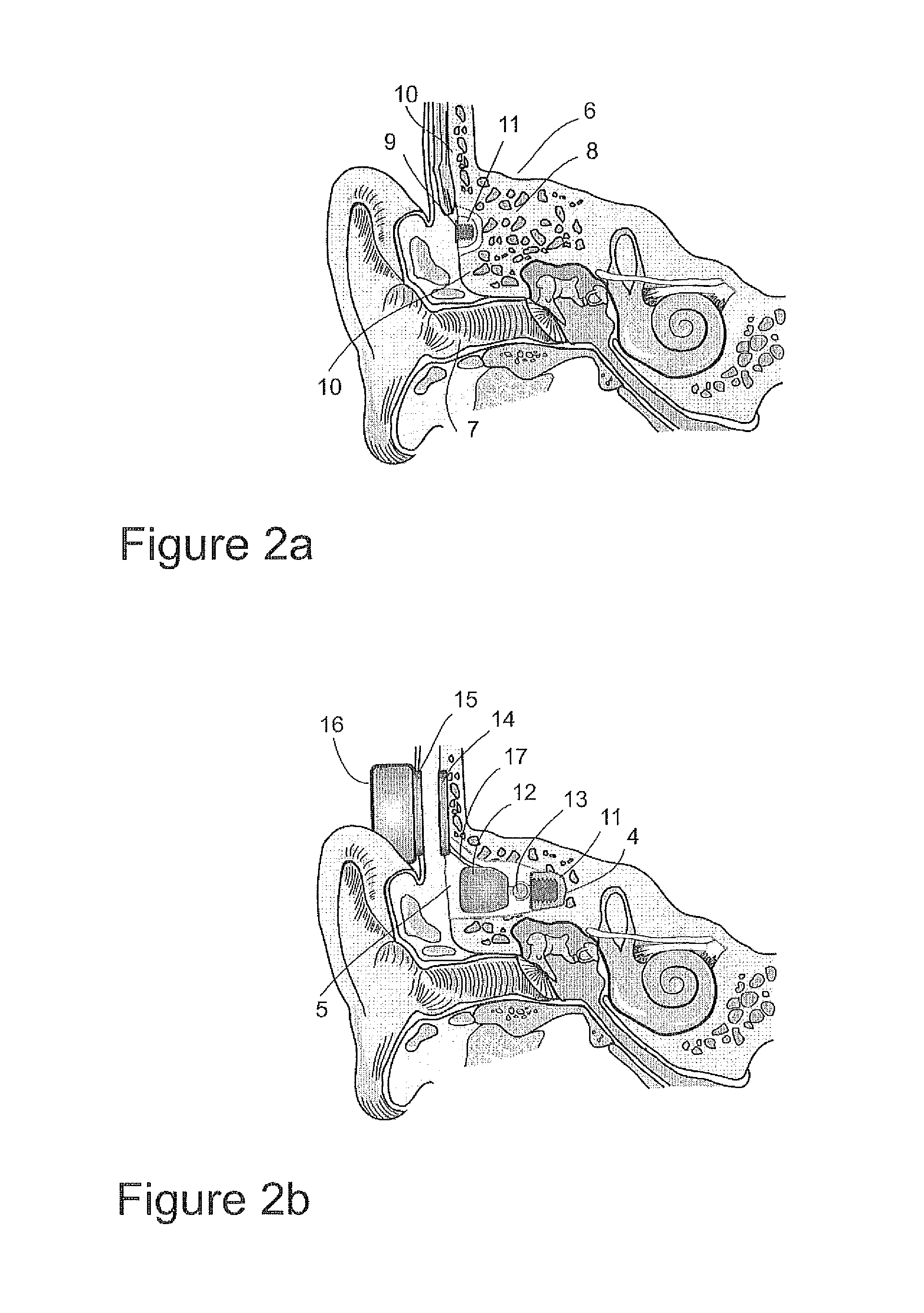 Implantable transducer