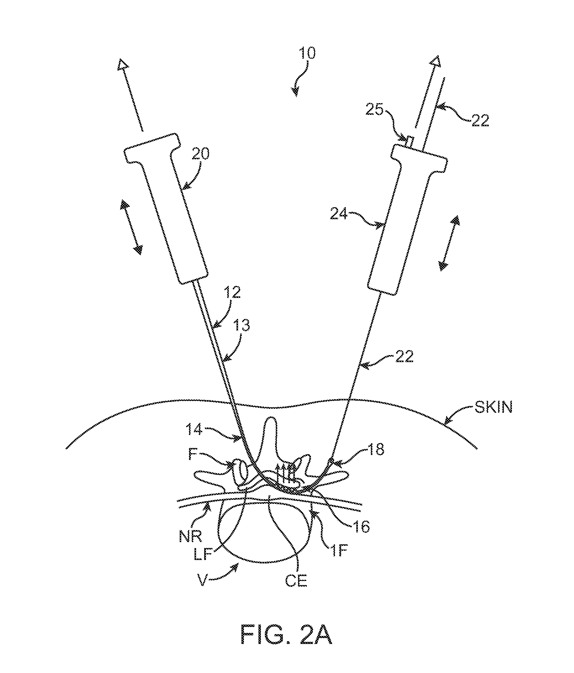 Methods, systems and devices for carpal tunnel release