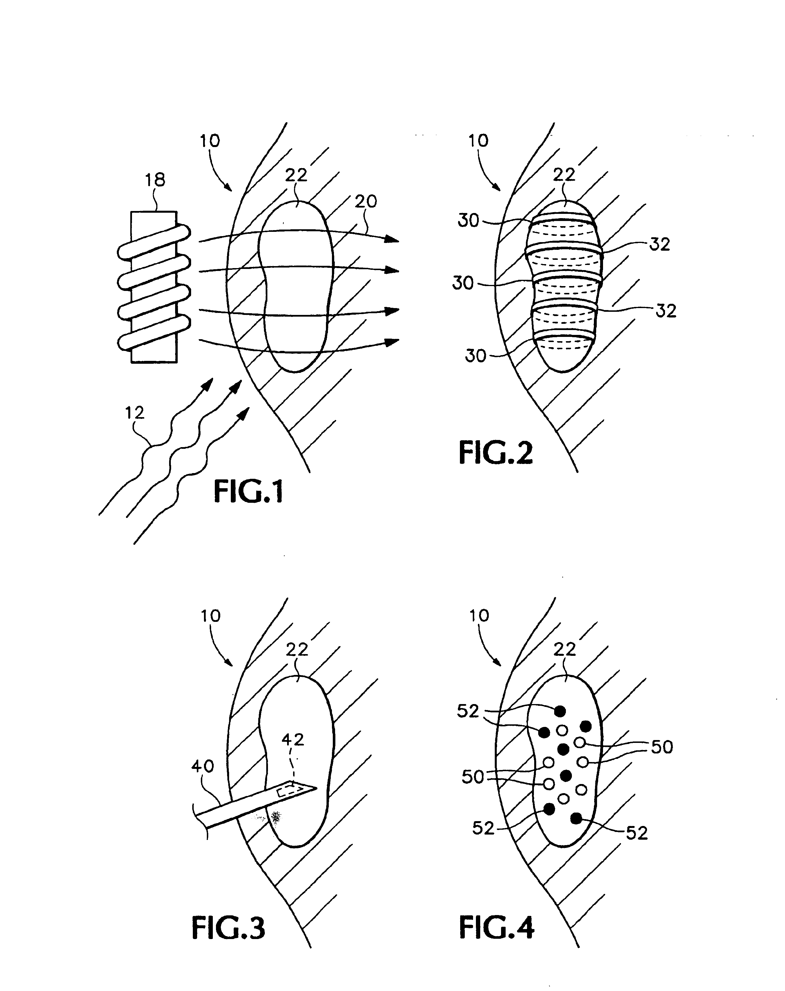 Magnetic field enhancement of tumor treatment