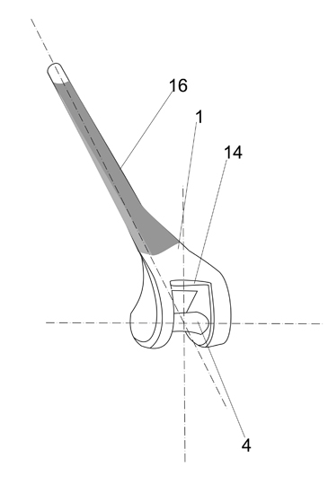 Design method of artificial elbow joint prosthesis with tantalum coating