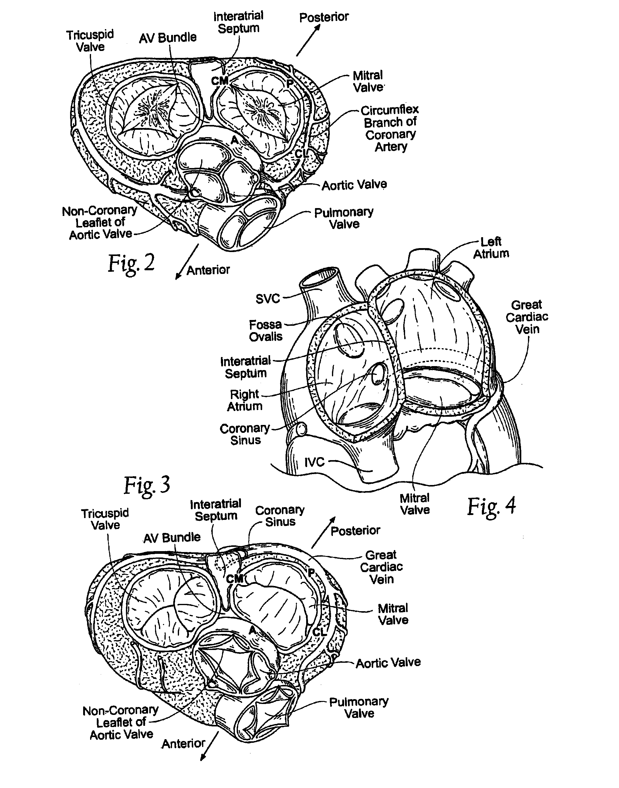 Methods of implanting a heart valve at an aortic annulus