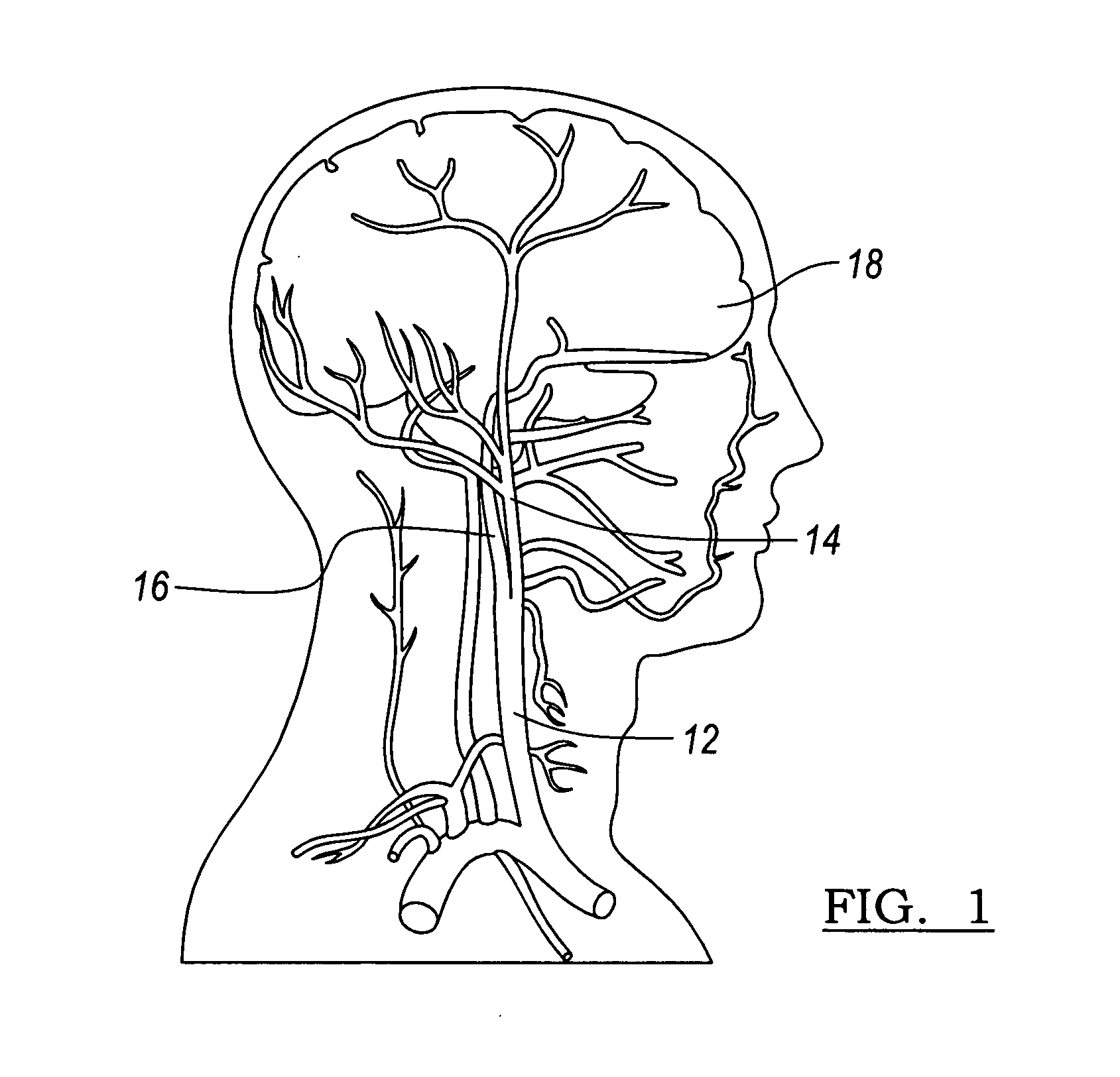 Vascular stent for embolic protection