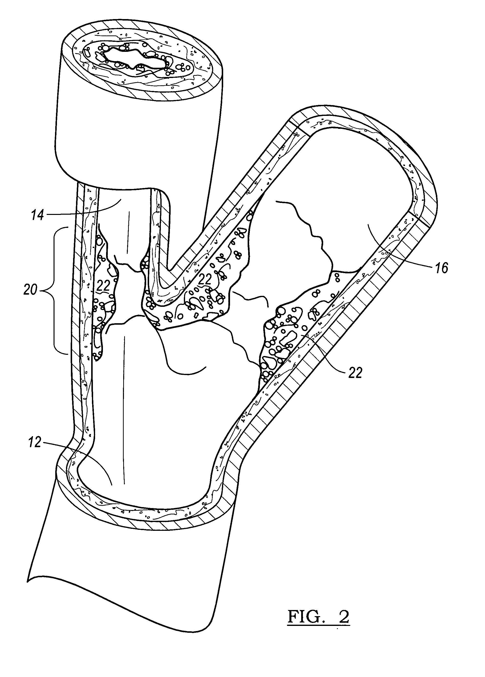 Vascular stent for embolic protection