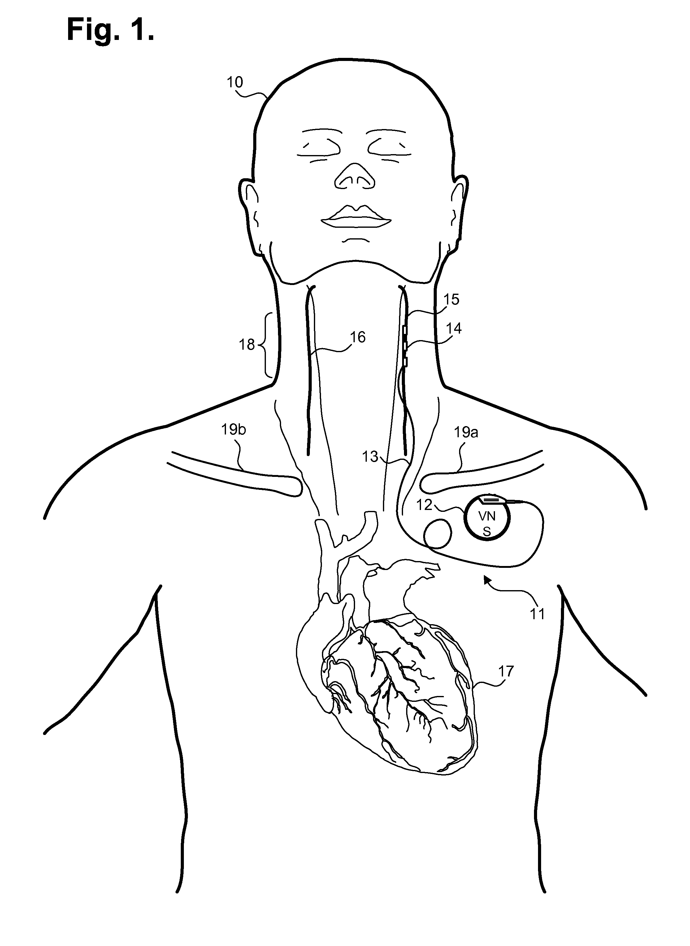 Implantable device for evaluating autonomic cardiovascular drive in a patient suffering from chronic cardiac dysfunction