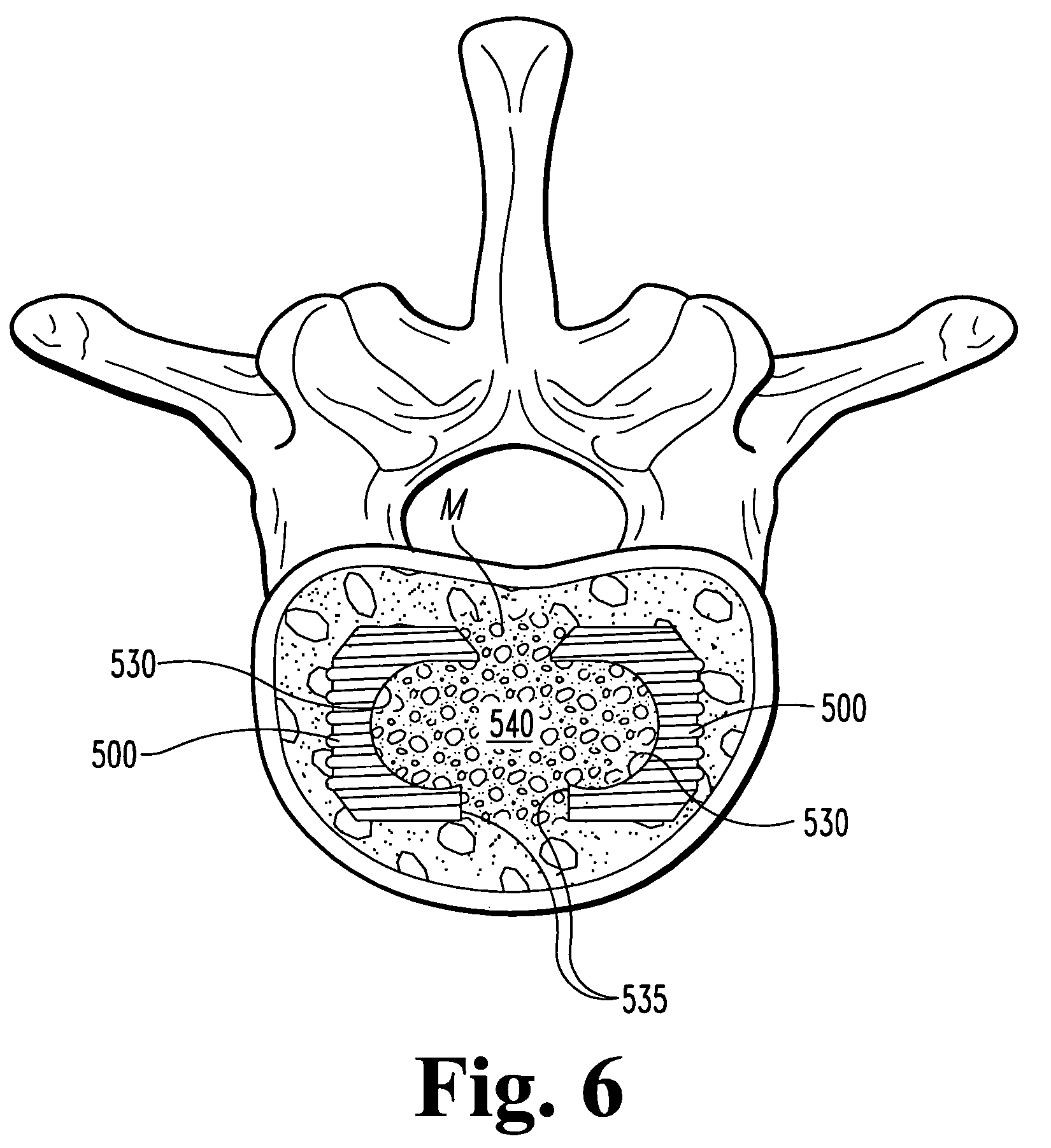 Open intervertebral spacer