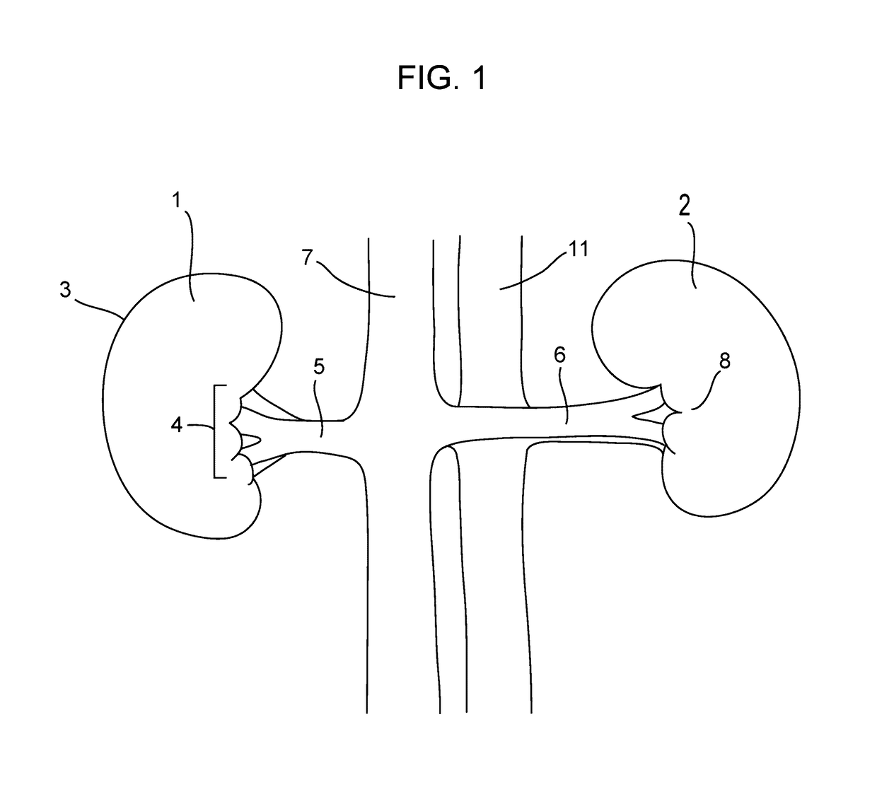 Aorticorenal Ganglion Detection