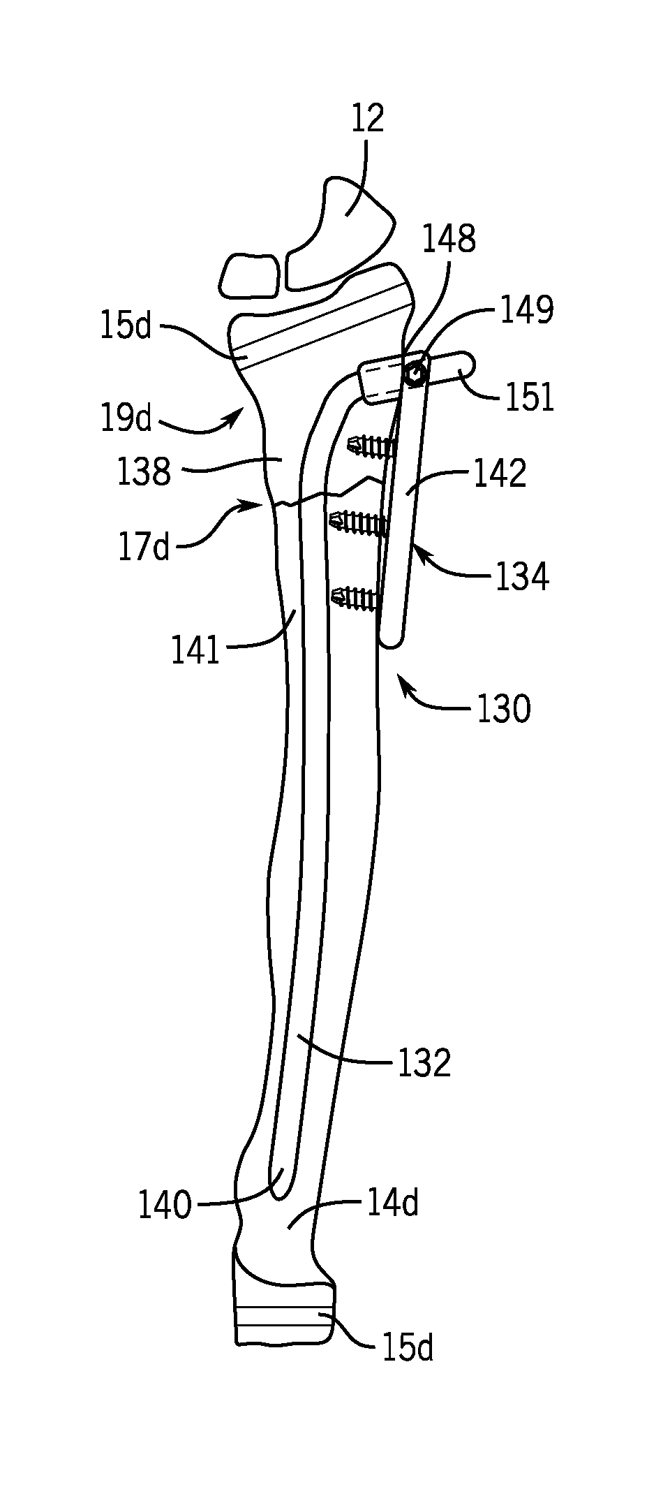 Fracture fixation device having clip for stabilizing intramedullary nail