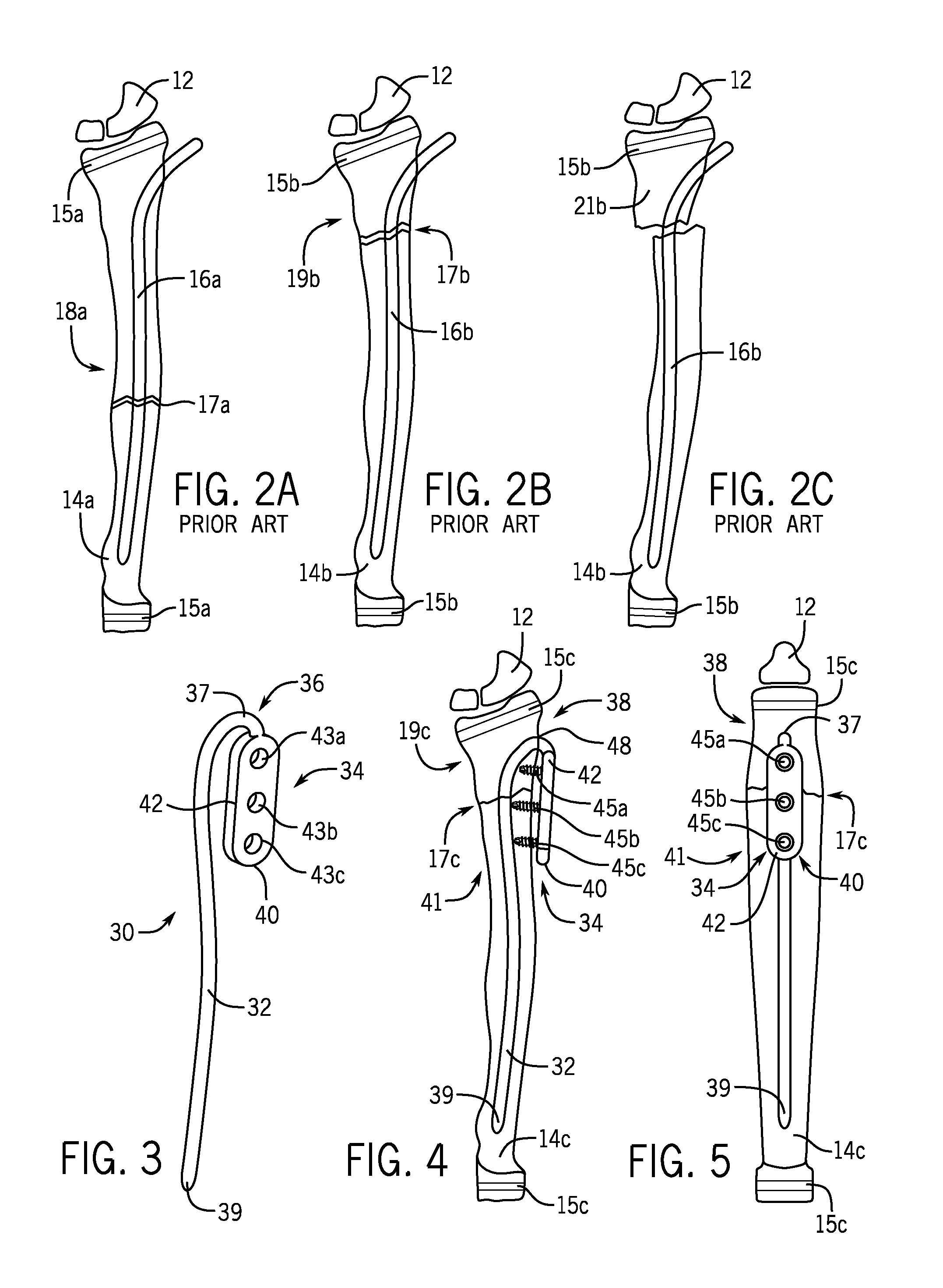 Fracture fixation device having clip for stabilizing intramedullary nail