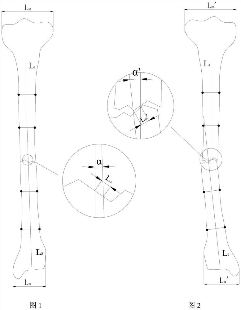 Reduction system for fracture and rotation deformity of lower limb bone