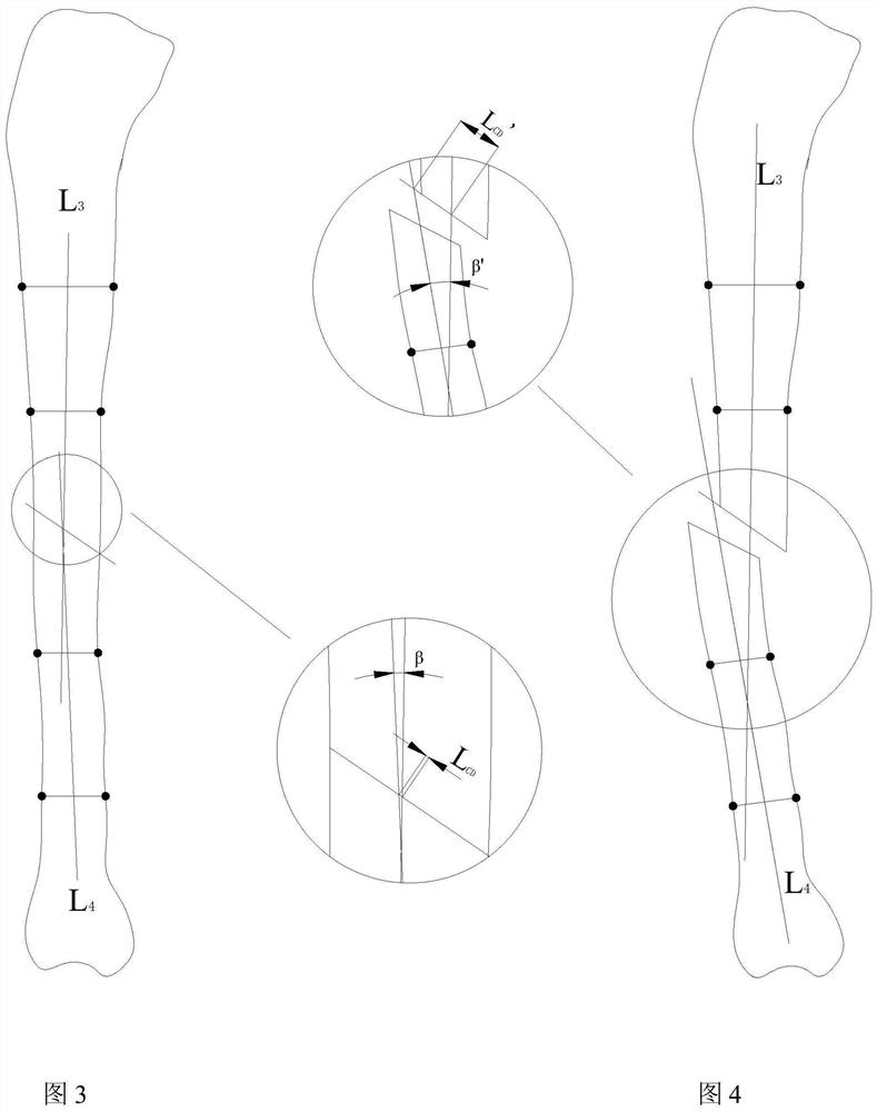 Reduction system for fracture and rotation deformity of lower limb bone