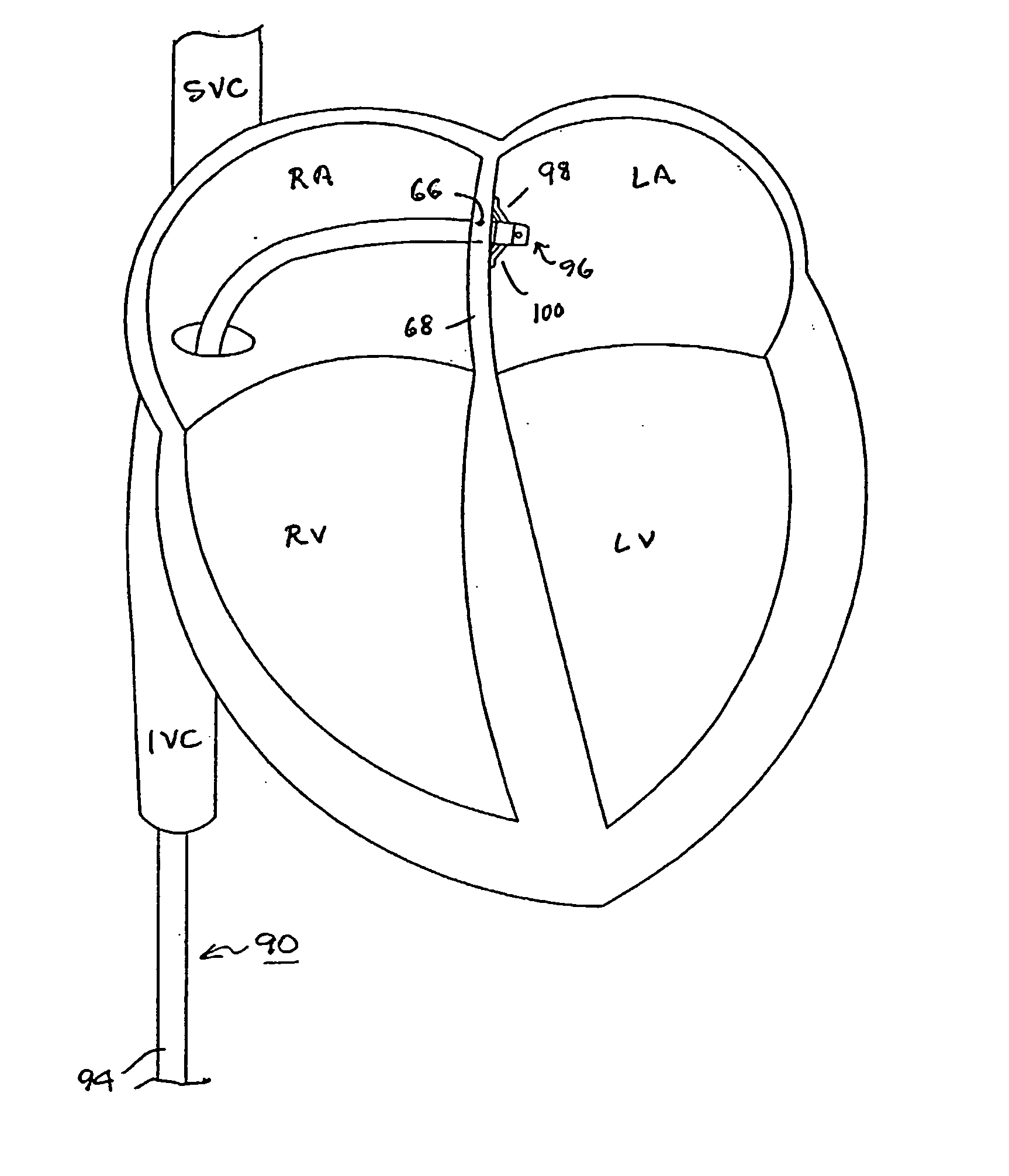 Trans-septal catheter with retention mechanism