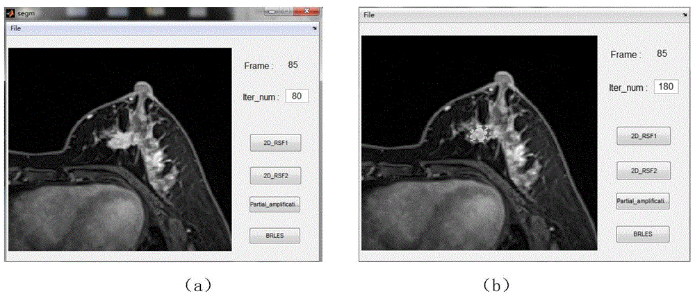 Breast tumor segmentation method based on MRI images