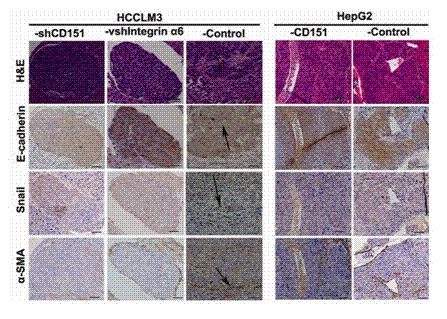 Animal model constructing method for studying epithelial and stromal hyalinosis of hepatocellular carcinoma