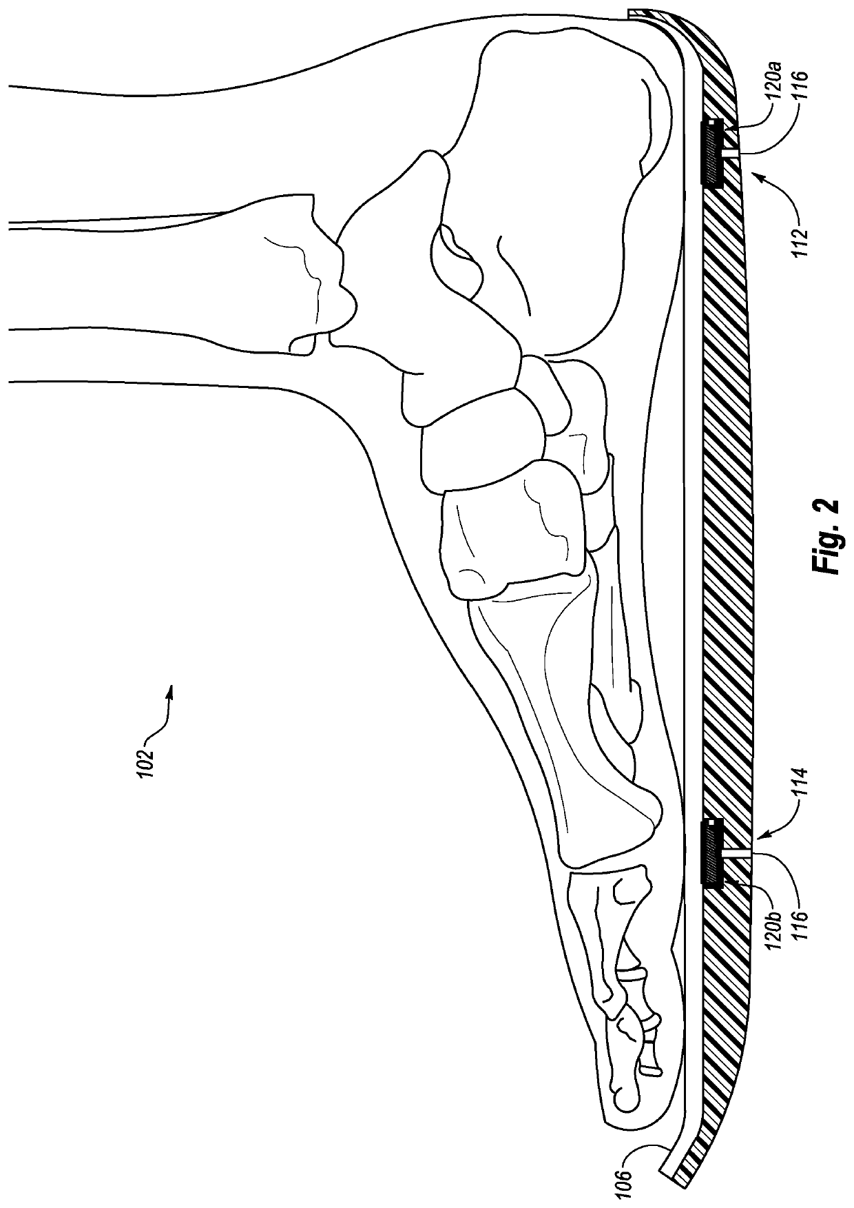 Systems, devices, and methods for providing foot loading feedback to patients and physicians during a period of partial weight bearing