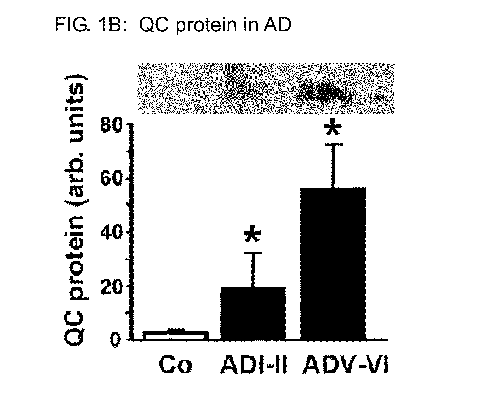 Glutaminyl cyclase as a diagnostic/prognostic indicator for neurodegenerative diseases