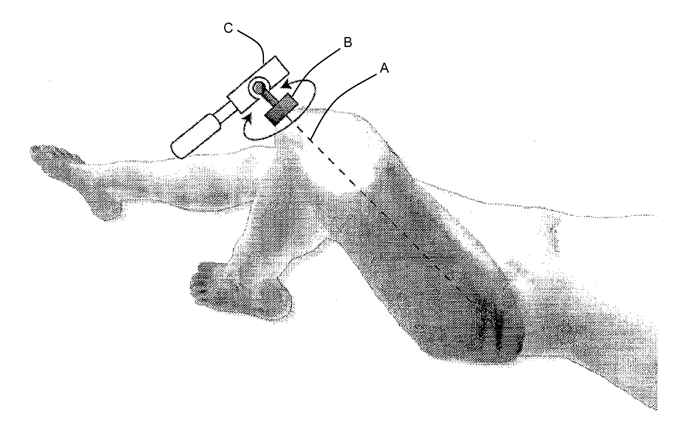 Bone tracking with a gyroscope sensor in computer-assisted surgery