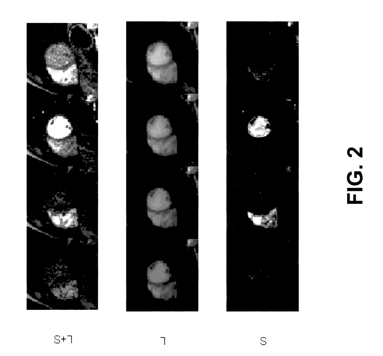 Low-Rank and Sparse Matrix Decomposition Based on Schatten p=1/2 and L1/2 Regularizations for Separation of Background and Dynamic Components for Dynamic MRI