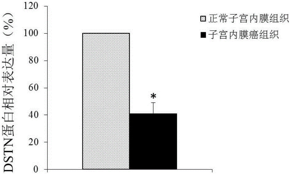 DSTN gene and expression product thereof as diagnosis and treatment target of endometrial cancer