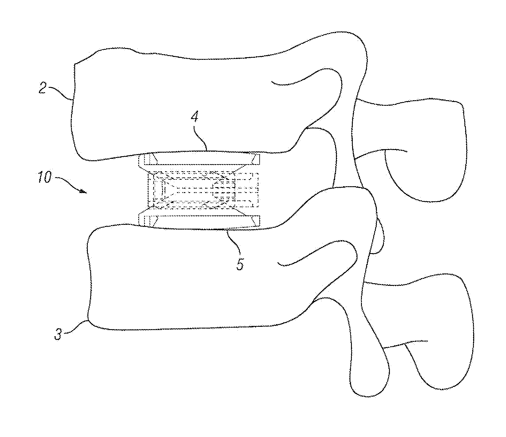 Expandable Fusion Device and Method of Installation Thereof