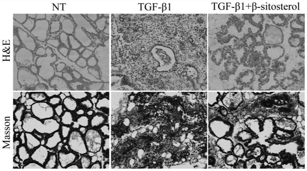 Experimental method of [beta]-sitosterol for relieving breast fibrosis diseases