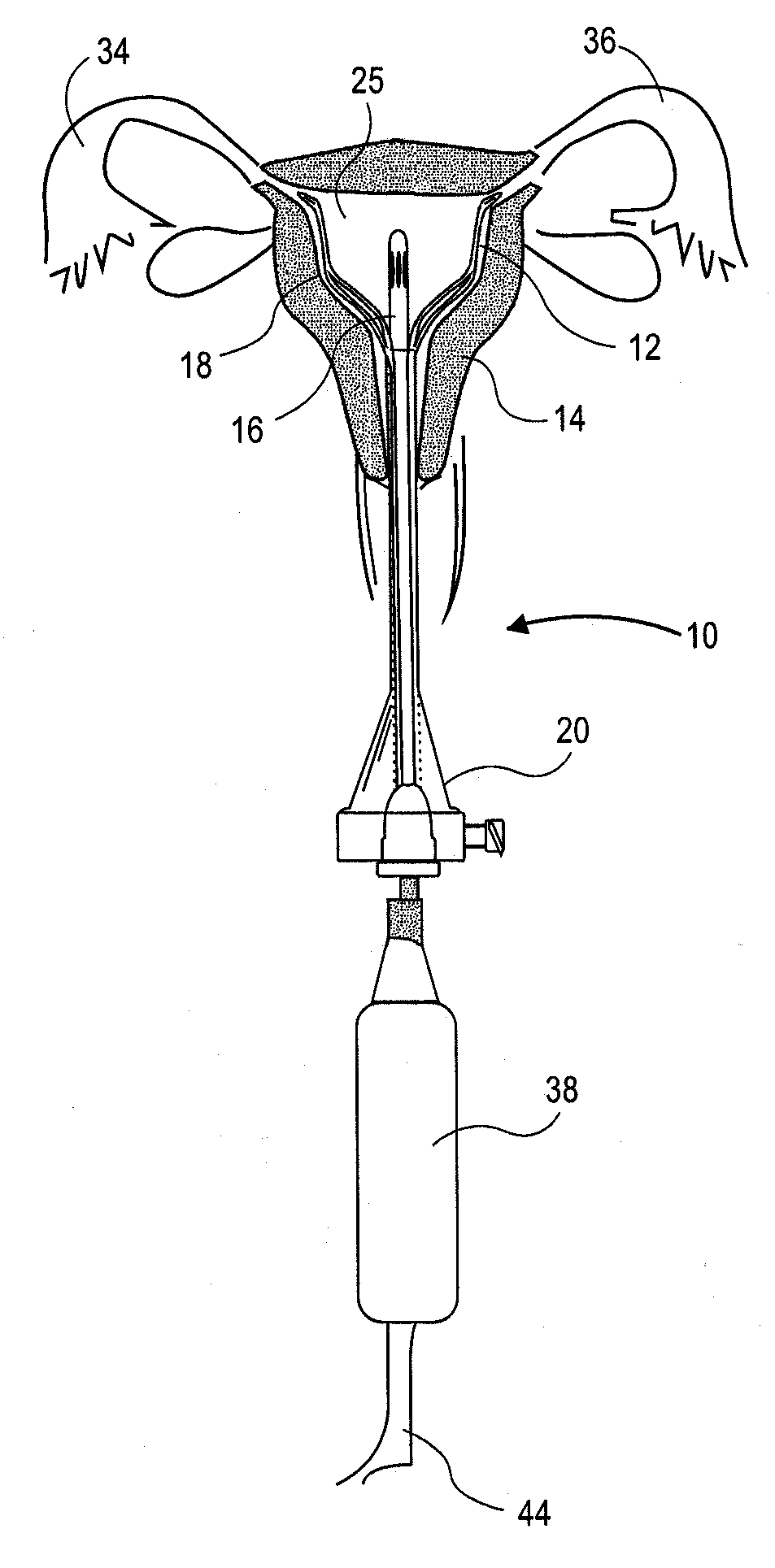 Uterine Therapy Device and Method