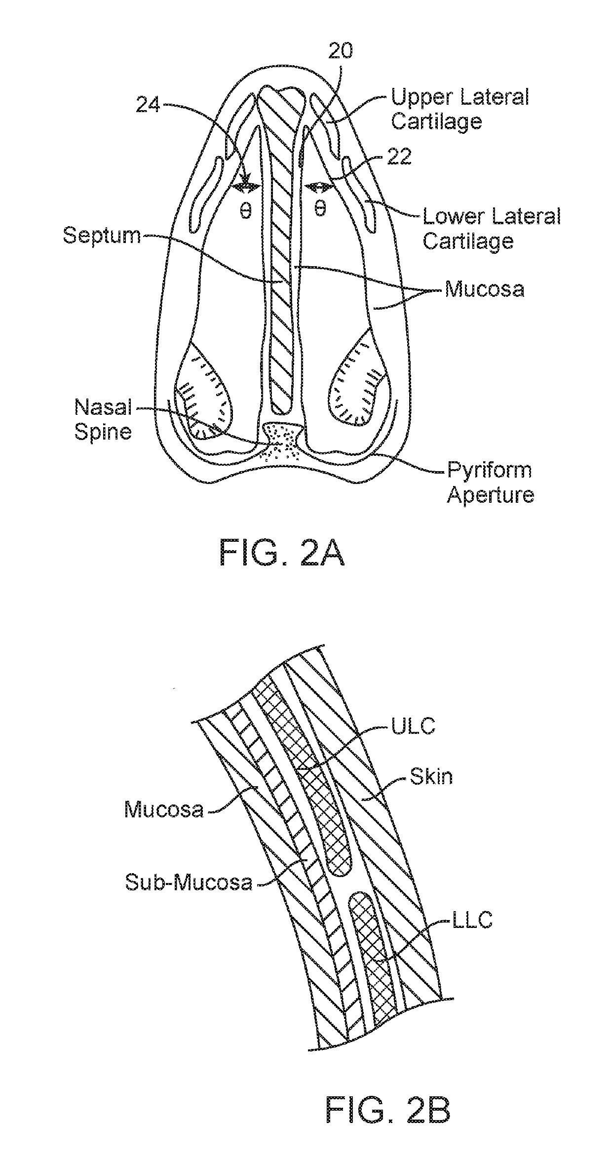 Methods and devices to treat nasal airways