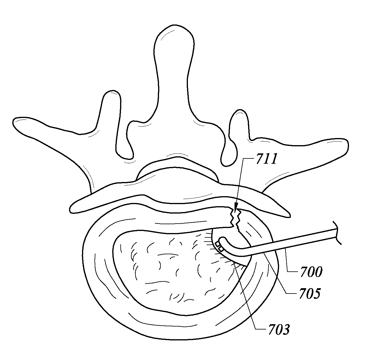 Systems and methods for electrosurgical intervertebral disc replacement