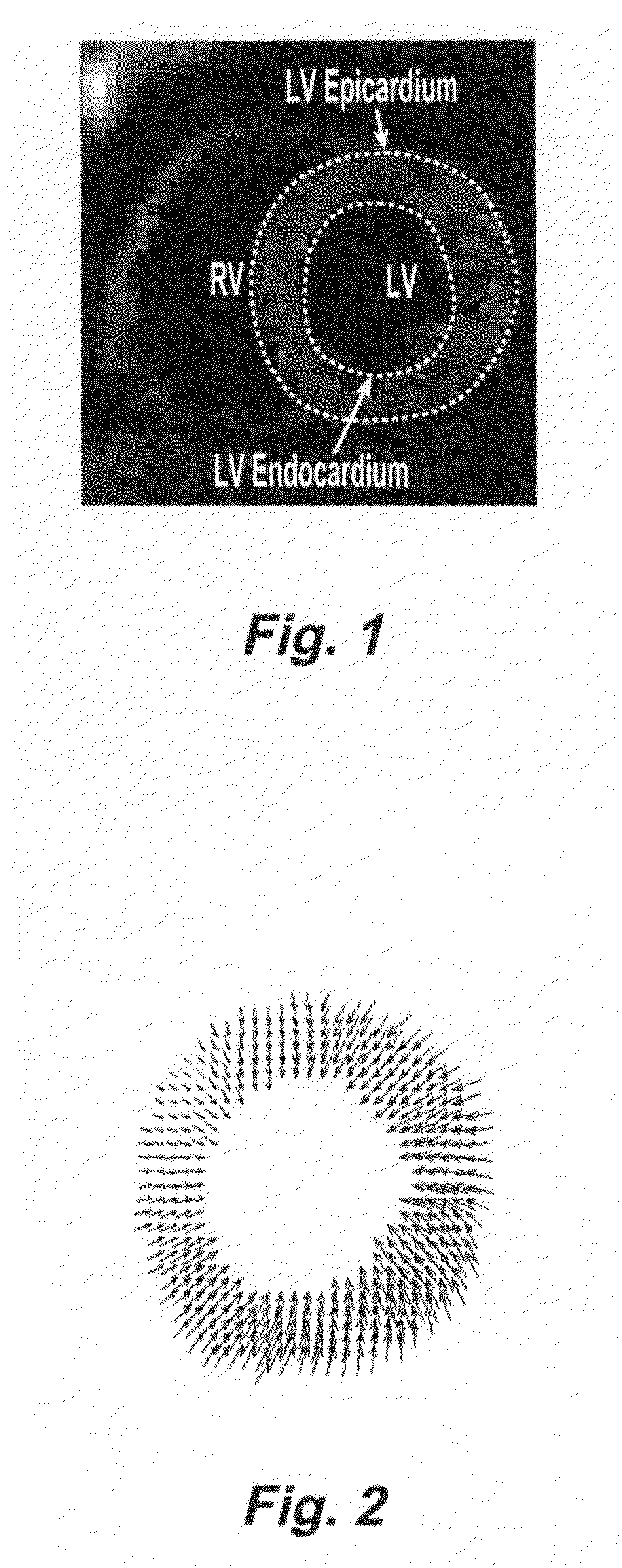 Motion-guided segmentation for cine DENSE images