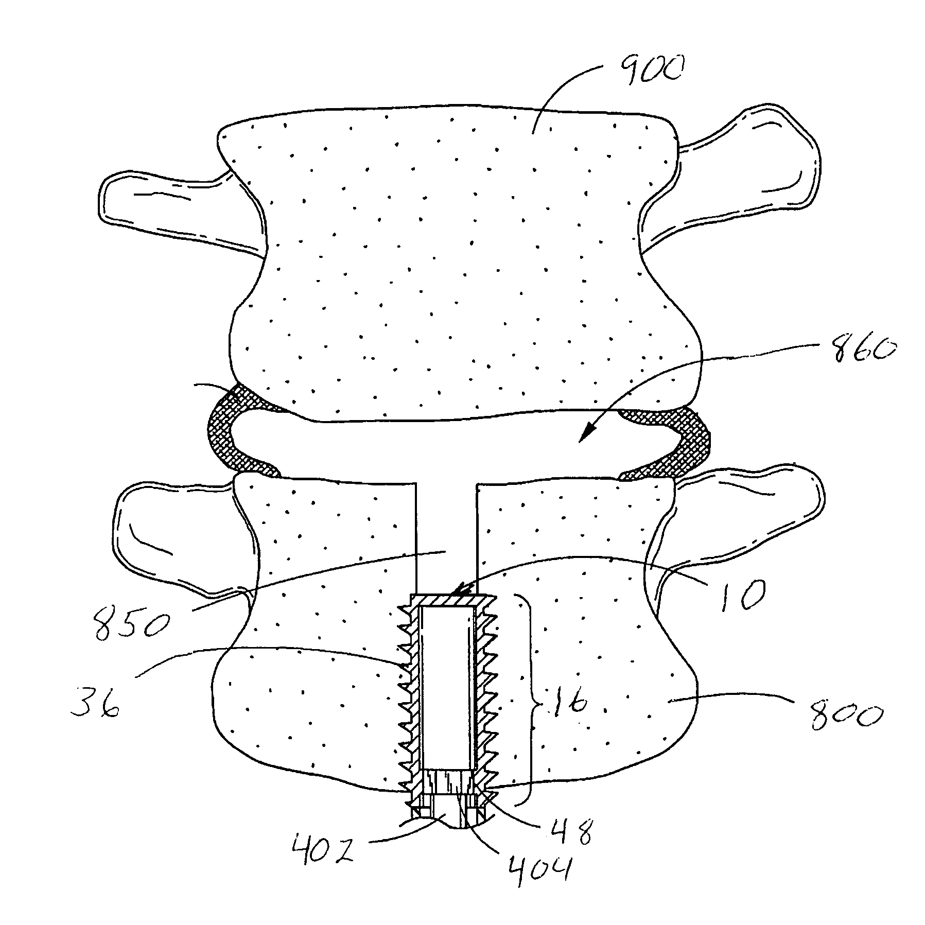 Prosthetic nucleus apparatus