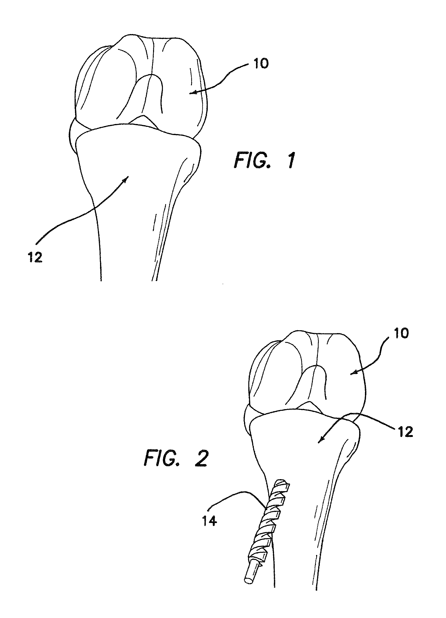 Devices, systems and methods for material fixation