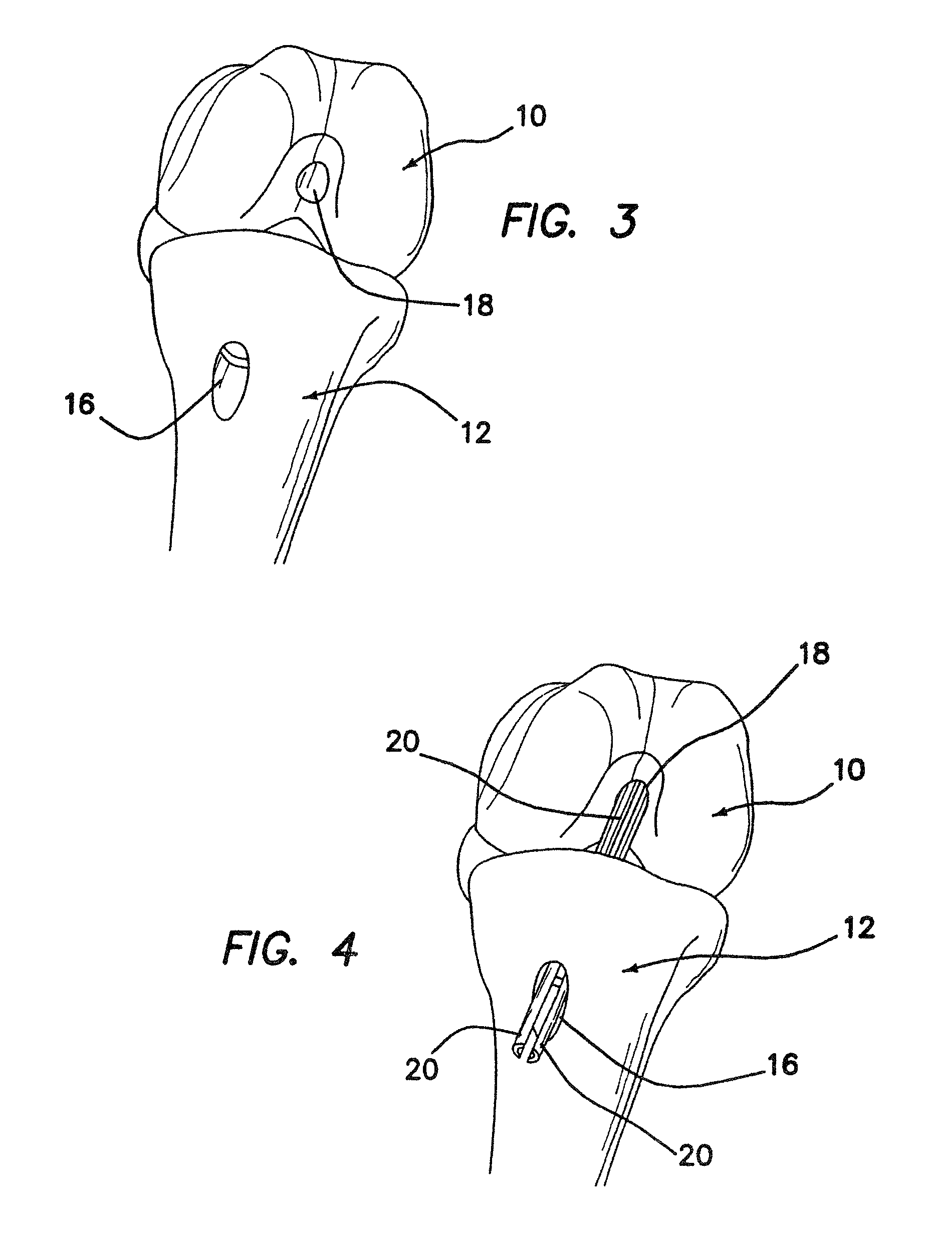 Devices, systems and methods for material fixation