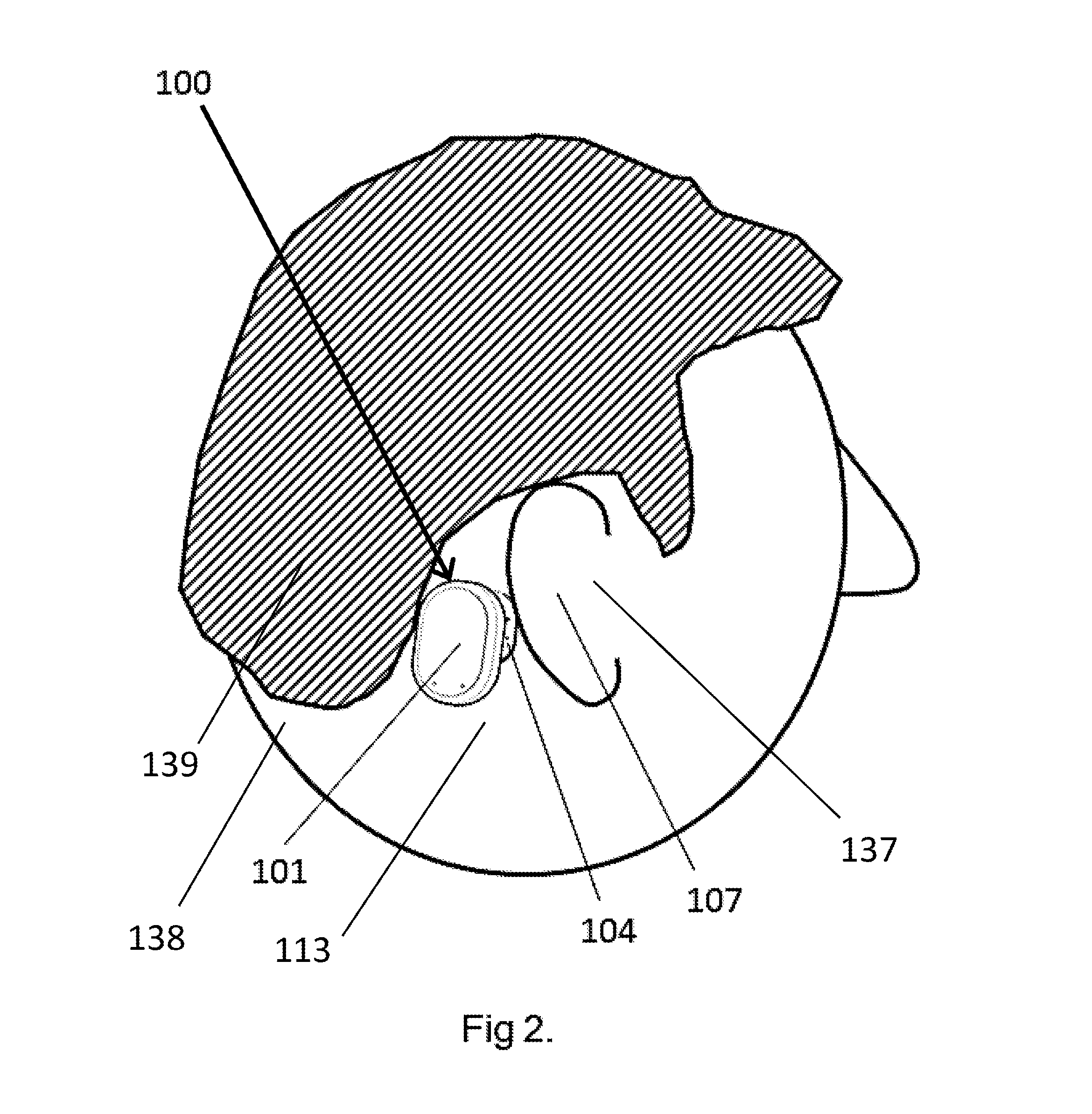 Bone Conduction Hearing Aid System