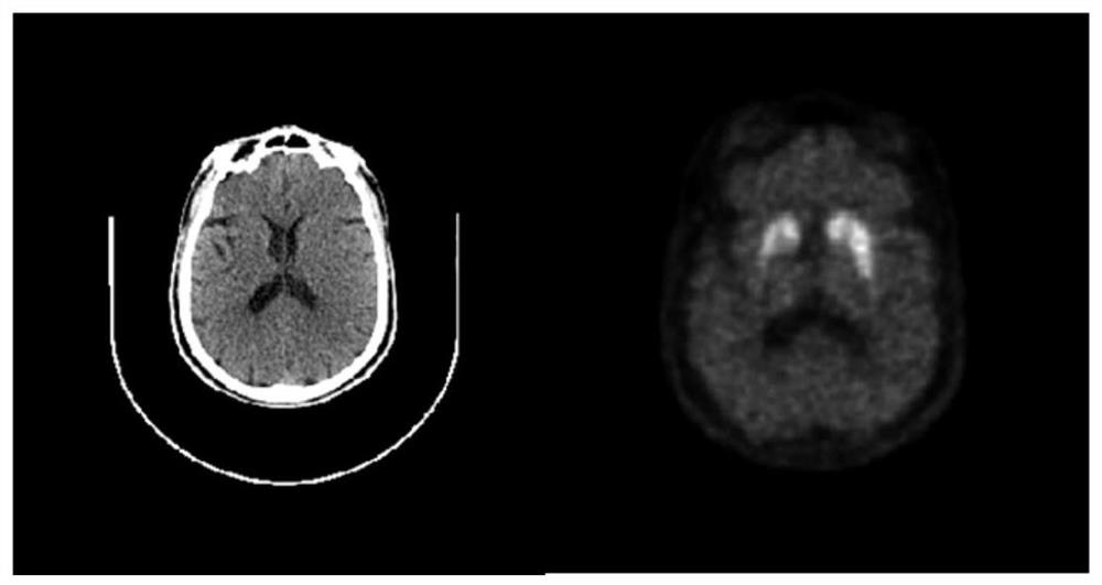 System for automatically analyzing dopamine transporter PET image based on CT structure image