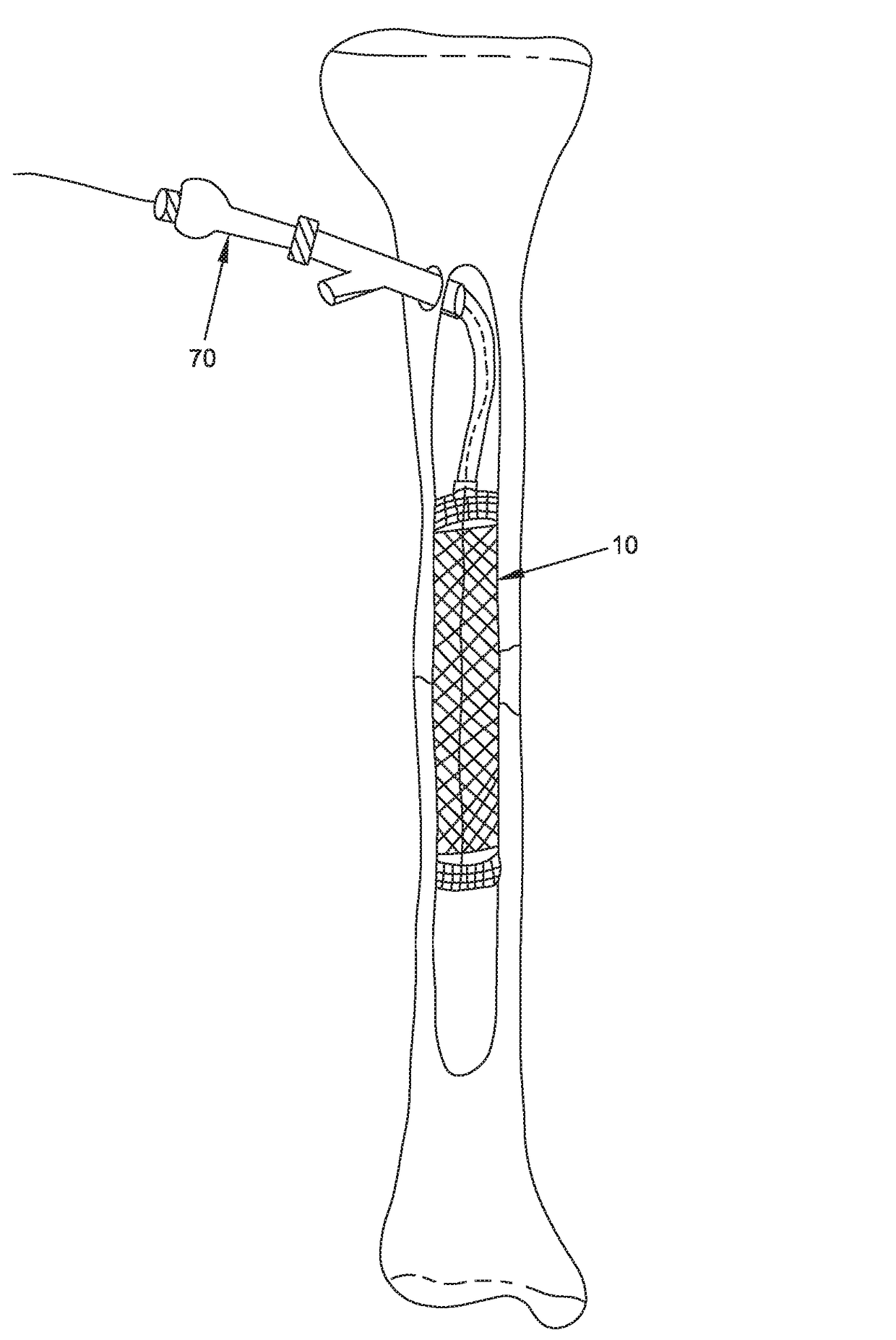 Method and apparatus for treating bone fractures, and/or for fortifying and/or augmenting bone, including the provision and use of composite implants