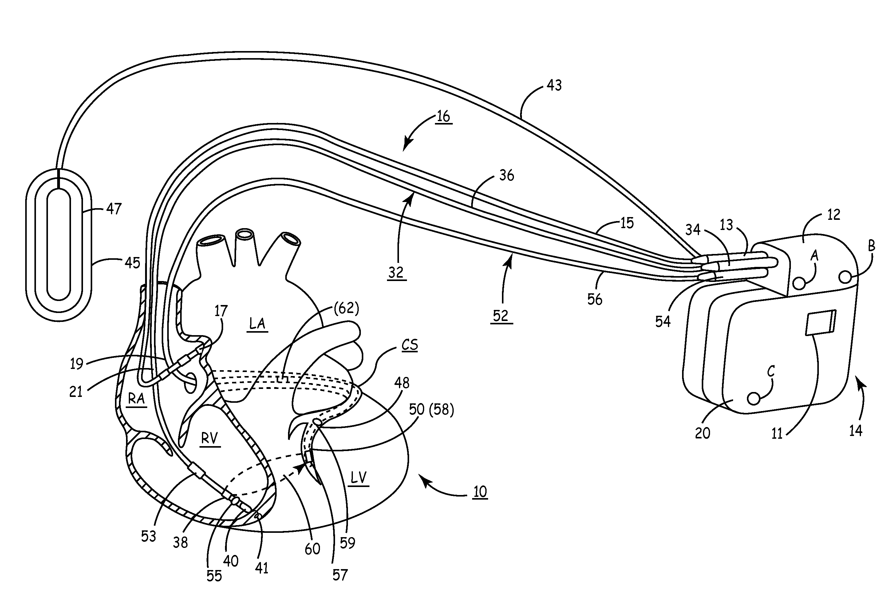 Closed loop optimization of a-v and v-v timing