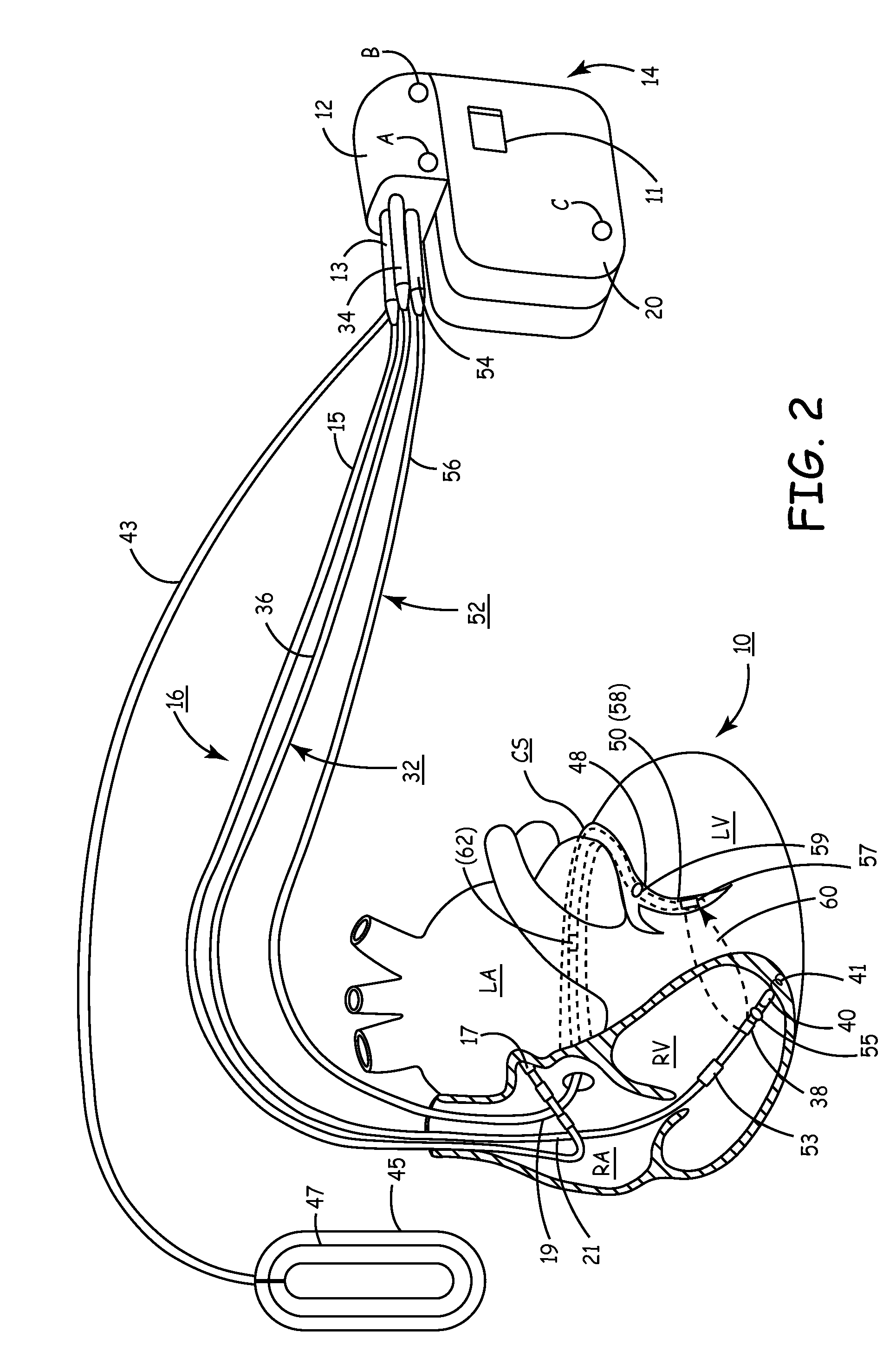 Closed loop optimization of a-v and v-v timing