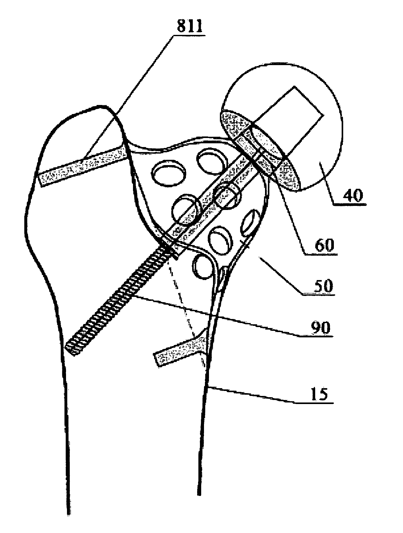 External proximal femoral prosthesis for total hip arthroplasty