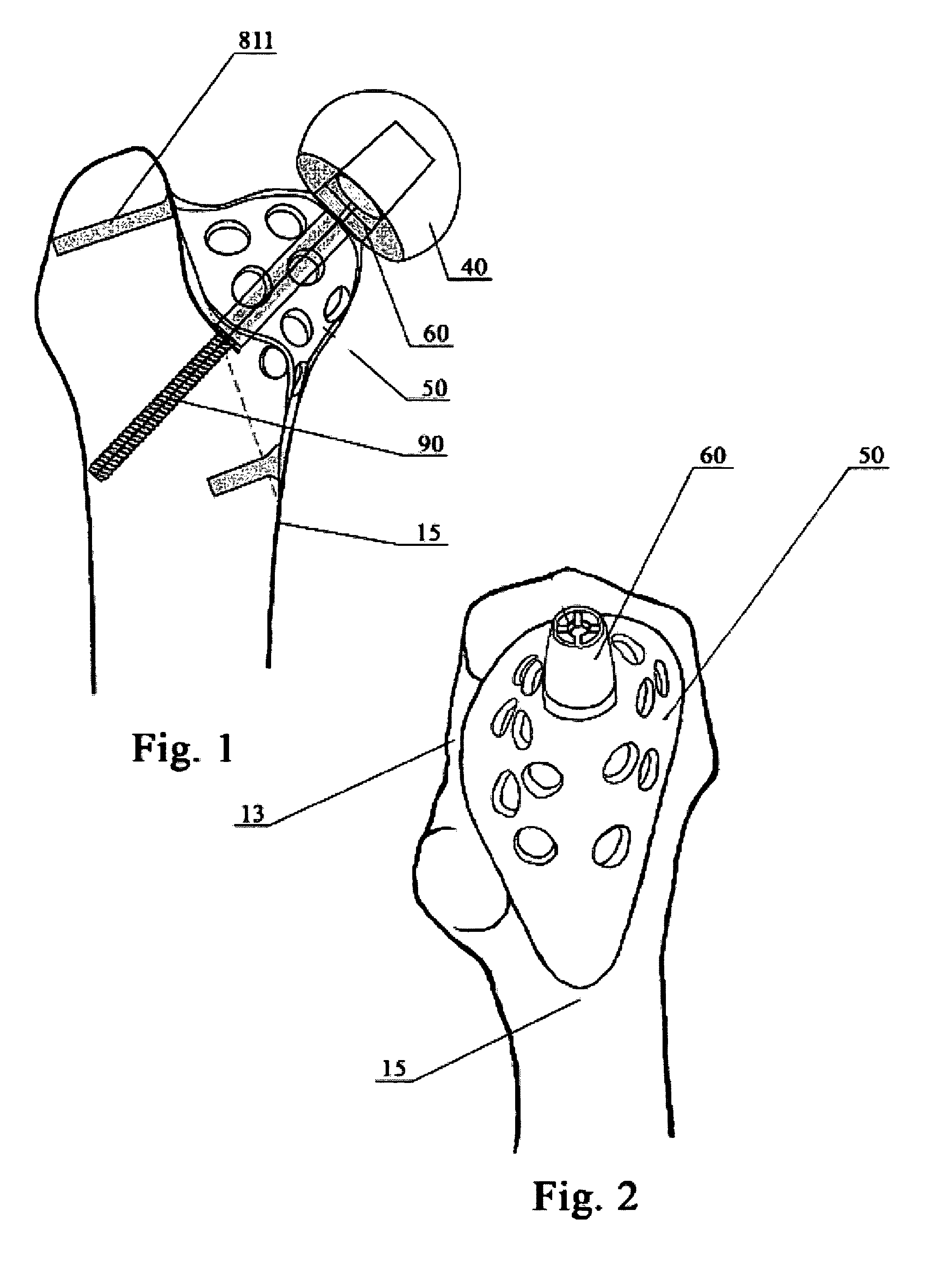 External proximal femoral prosthesis for total hip arthroplasty