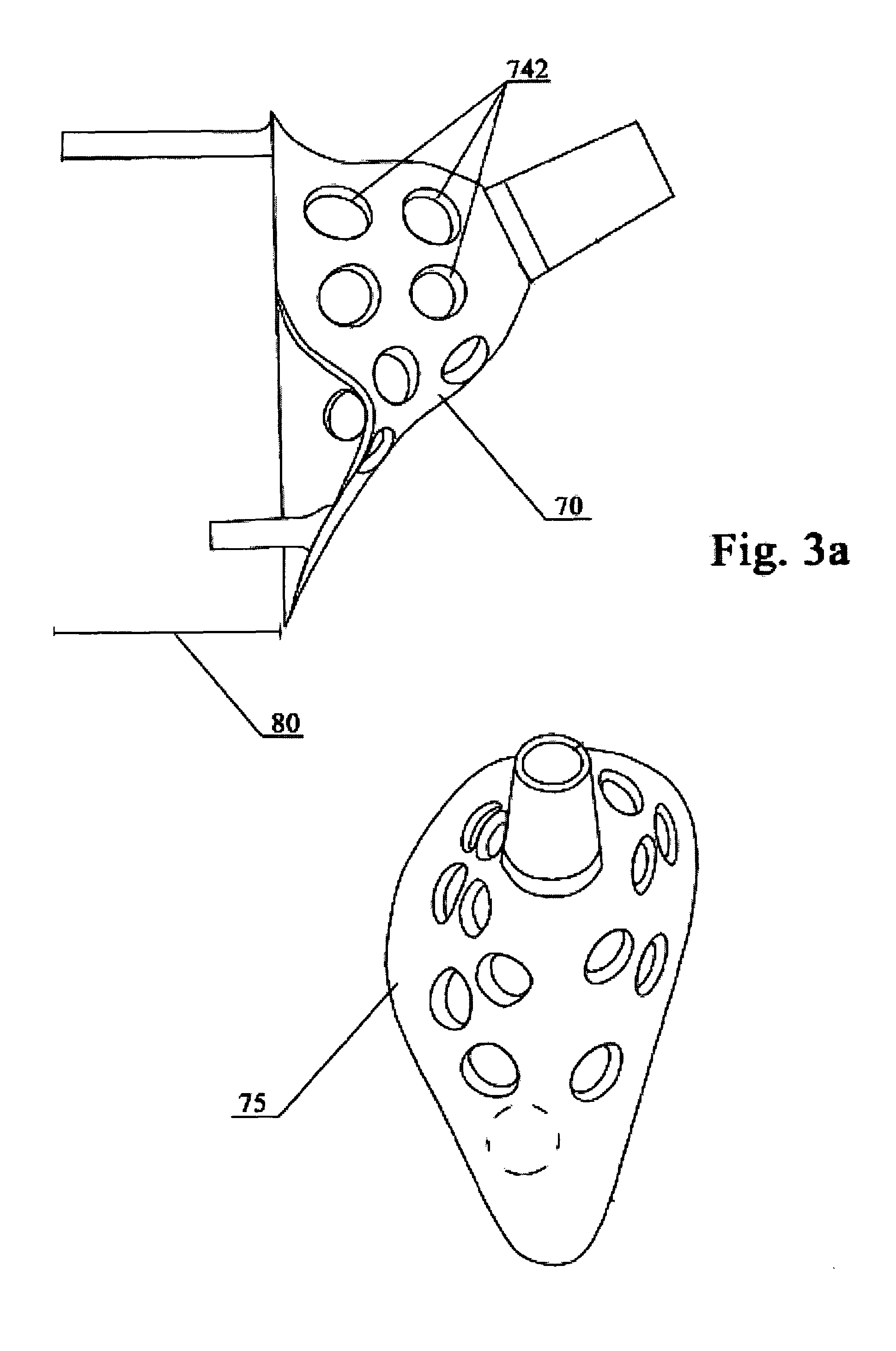 External proximal femoral prosthesis for total hip arthroplasty