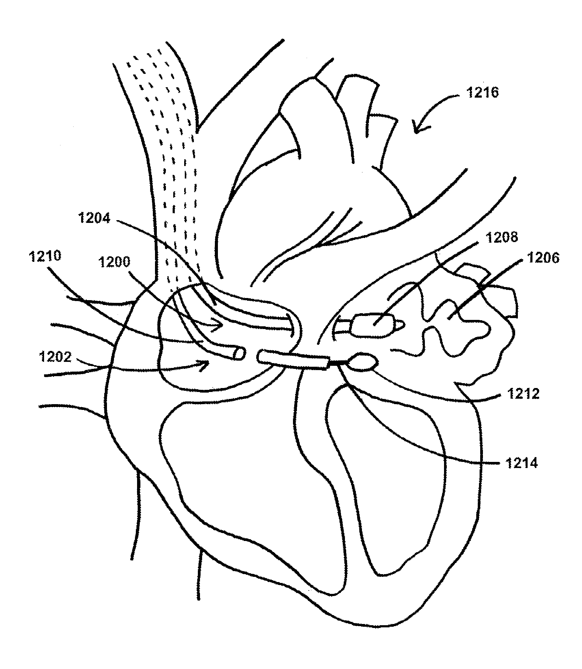 Devices, systems, and methods for percutaneous trans-septal left atrial appendage occlusion