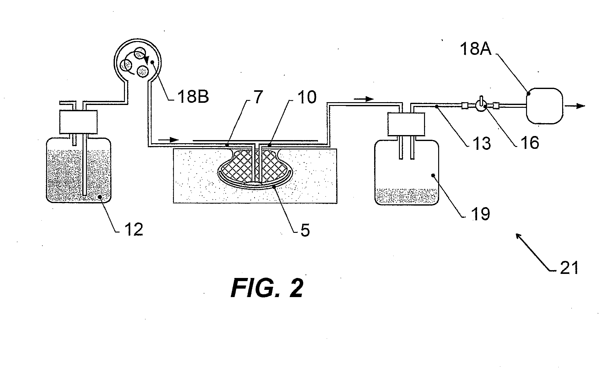 Wound treatment apparatus and method