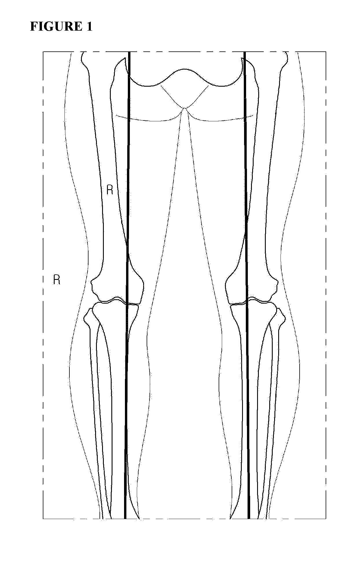 Fixing tool for open-wedge high tibial osteotomy