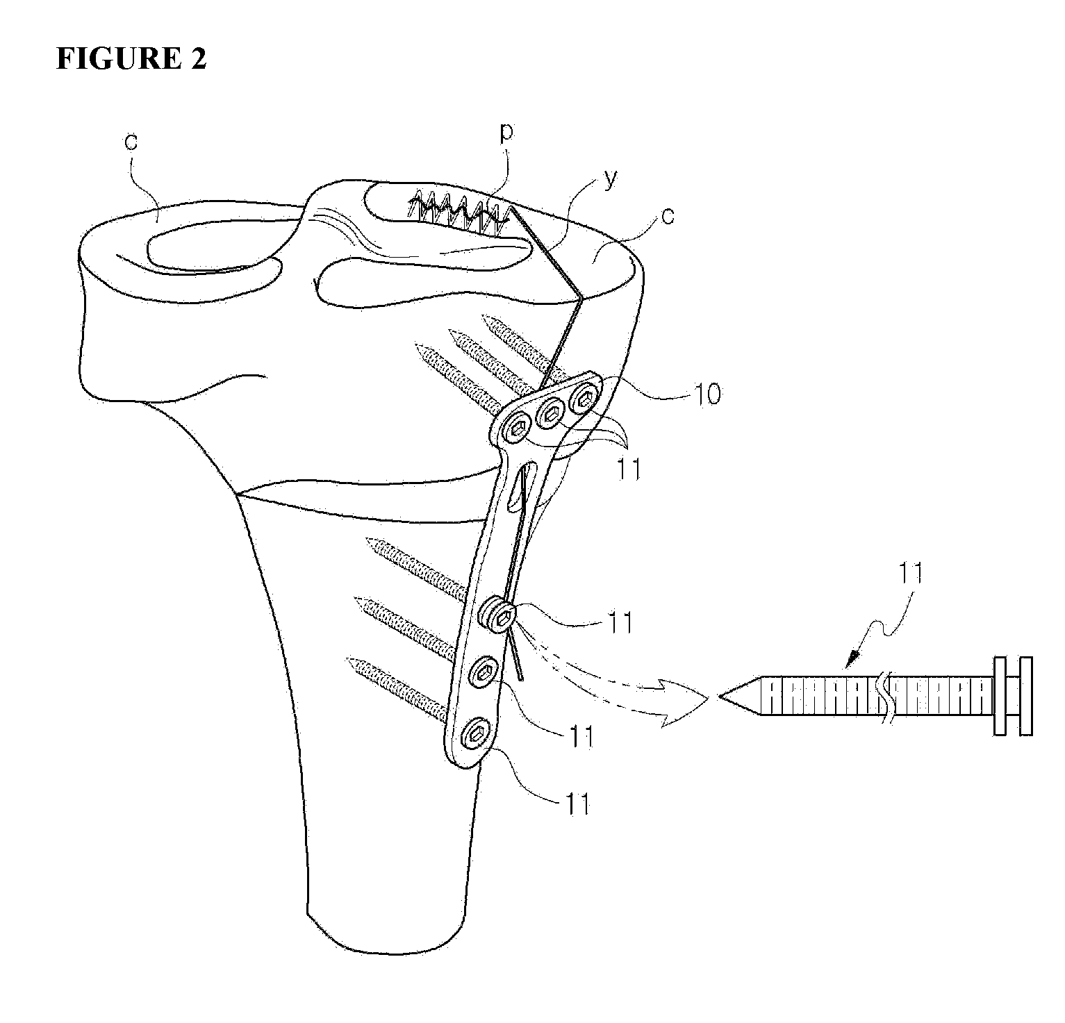 Fixing tool for open-wedge high tibial osteotomy