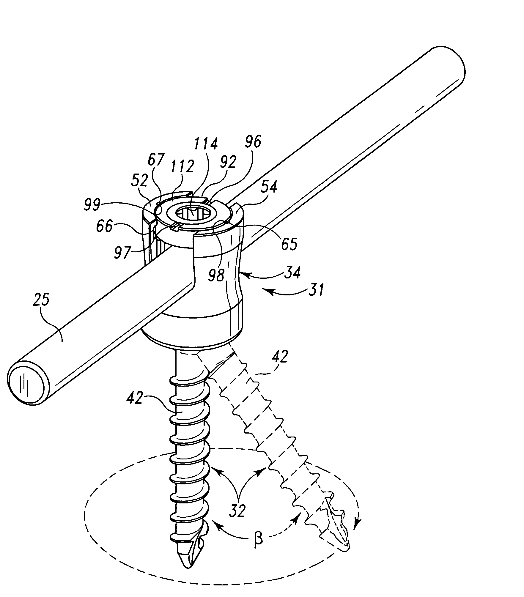 Pedicle screw constructs for spine fixation systems