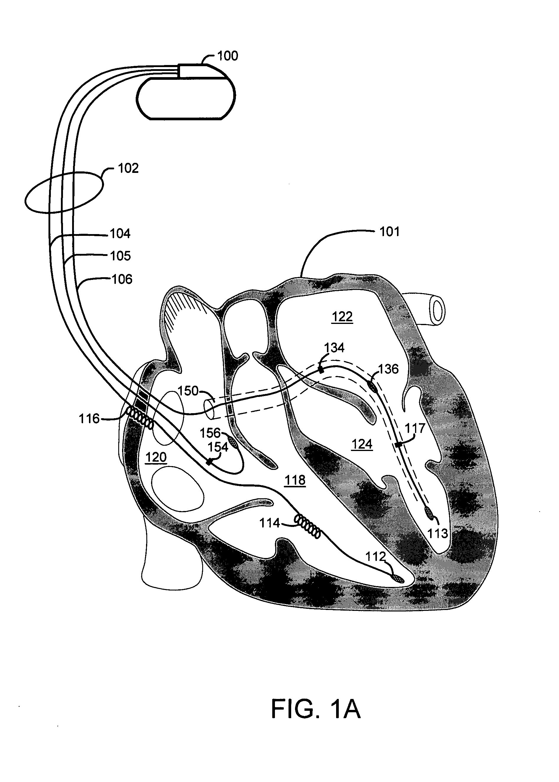 Timing cycles for synchronized multisite cardiac pacing